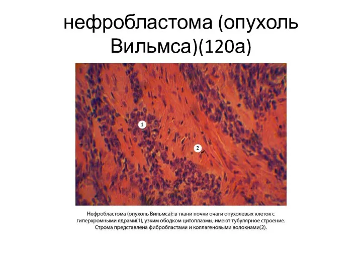 нефробластома (опухоль Вильмса)(120а)