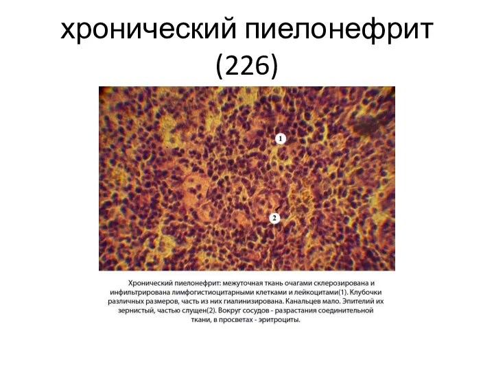 хронический пиелонефрит(226)