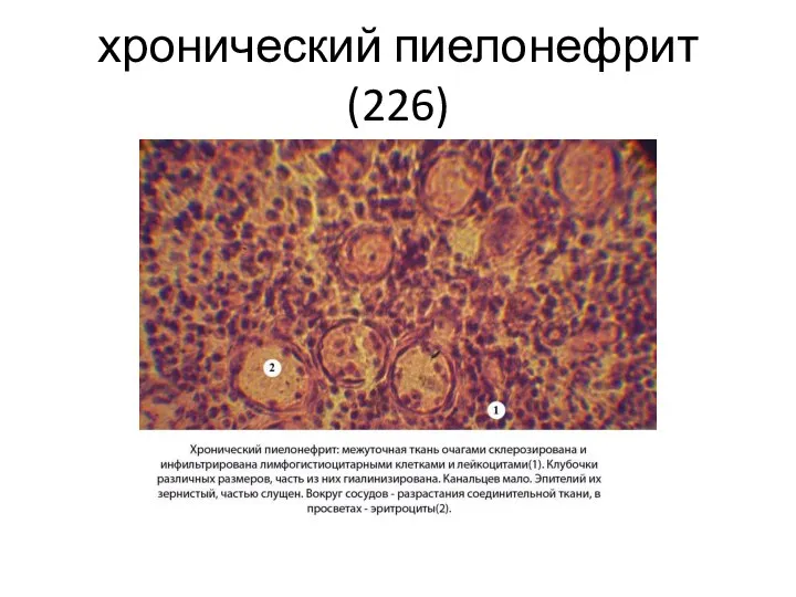 хронический пиелонефрит(226)