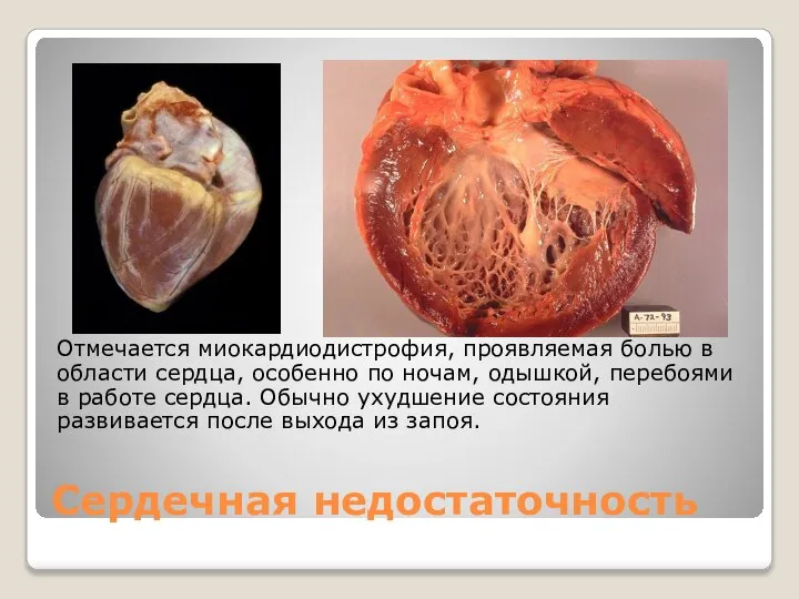 Сердечная недостаточность Отмечается миокардиодистрофия, проявляемая болью в области сердца, особенно по ночам,