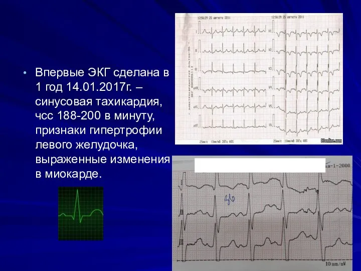 Впервые ЭКГ сделана в 1 год 14.01.2017г. – синусовая тахикардия, чсс 188-200