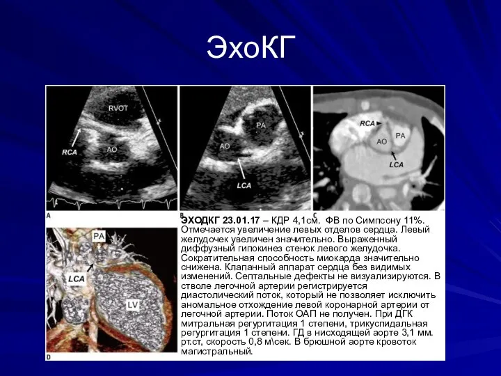 ЭхоКГ ЭХОДКГ 23.01.17 – КДР 4,1см. ФВ по Симпсону 11%. Отмечается увеличение