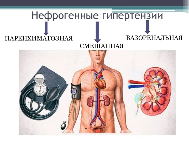 Нефрогенные гипертензии ПАРЕНХИМАТОЗНАЯ ВАЗОРЕНАЛЬНАЯ СМЕШАННАЯ