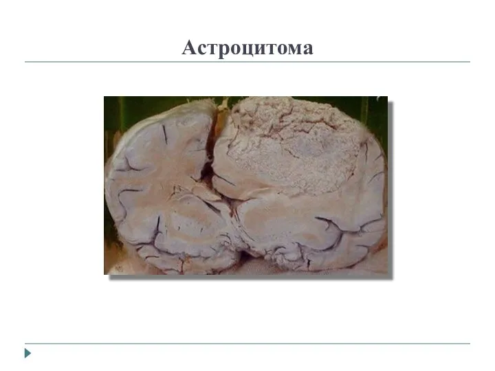 Астроцитома