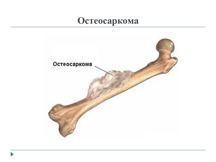 Остеосаркома