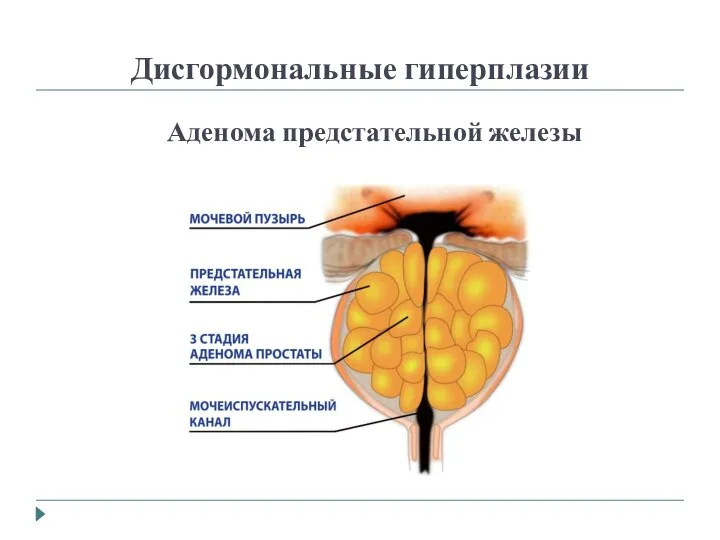 Дисгормональные гиперплазии Аденома предстательной железы