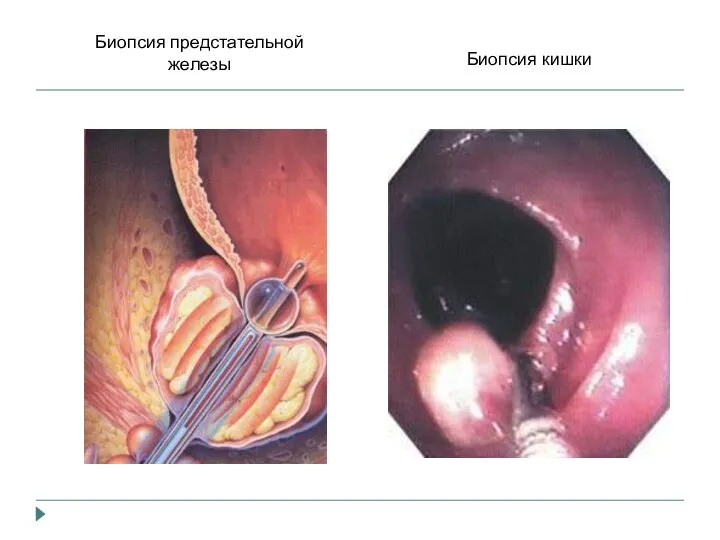 Биопсия кишки Биопсия предстательной железы