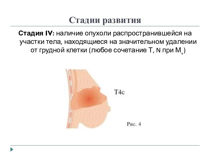 Стадии развития Стадия IV: наличие опухоли распространившейся на участки тела, находящиеся на