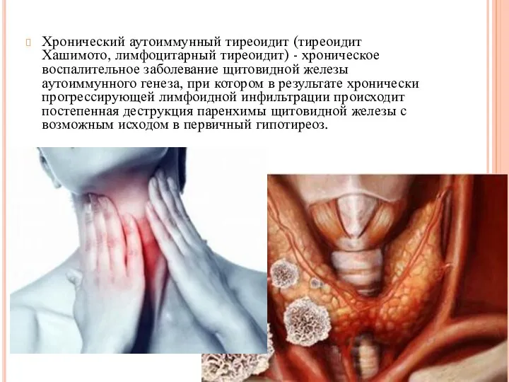 Хронический аутоиммунный тиреоидит (тиреоидит Хашимото, лимфоцитарный тиреоидит) - хроническое воспалительное заболевание щитовидной
