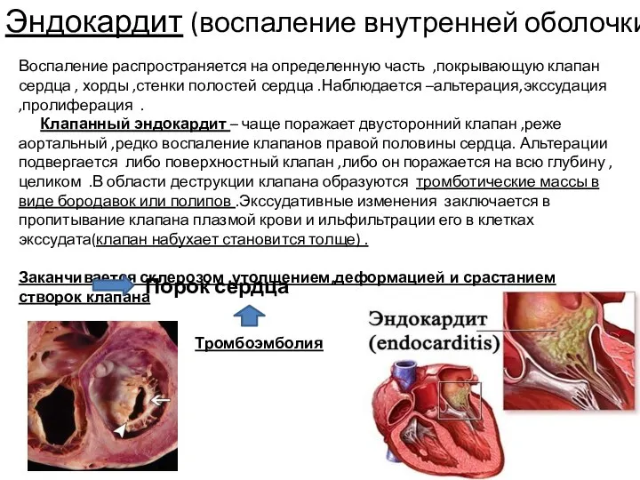 Эндокардит (воспаление внутренней оболочки) Воспаление распространяется на определенную часть ,покрывающую клапан сердца