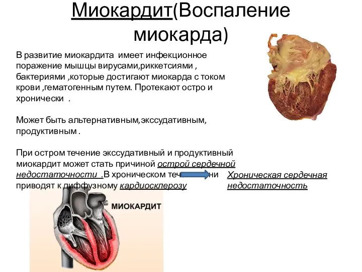 Миокардит(Воспаление миокарда) В развитие миокардита имеет инфекционное поражение мышцы вирусами,риккетсиями ,бактериями ,которые