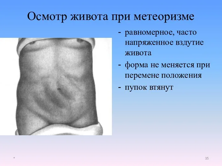 равномерное, часто напряженное вздутие живота форма не меняется при перемене положения пупок