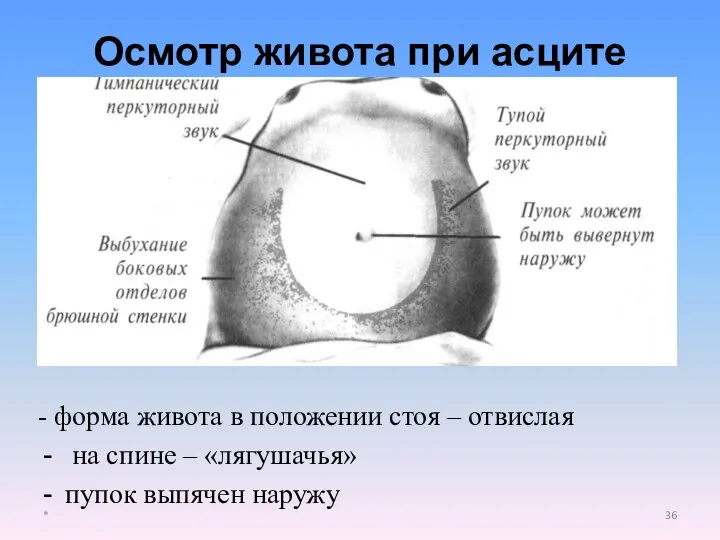 - форма живота в положении стоя – отвислая на спине – «лягушачья»