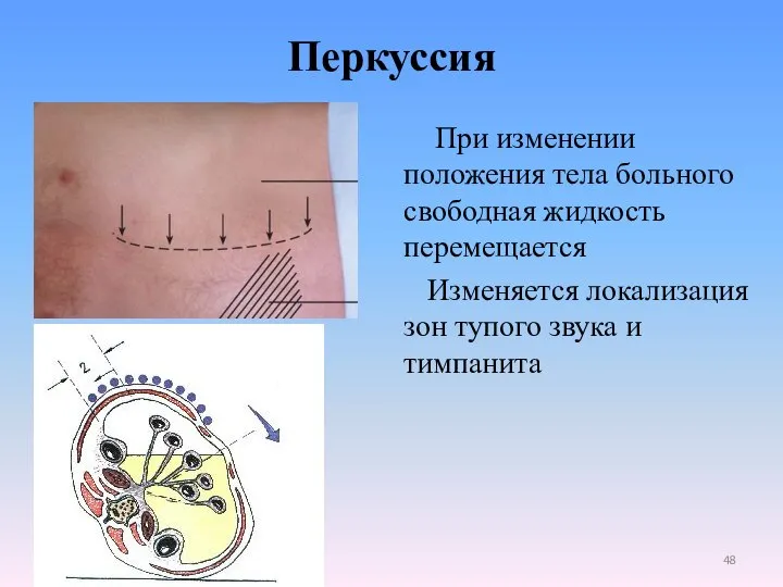 При изменении положения тела больного свободная жидкость перемещается Изменяется локализация зон тупого