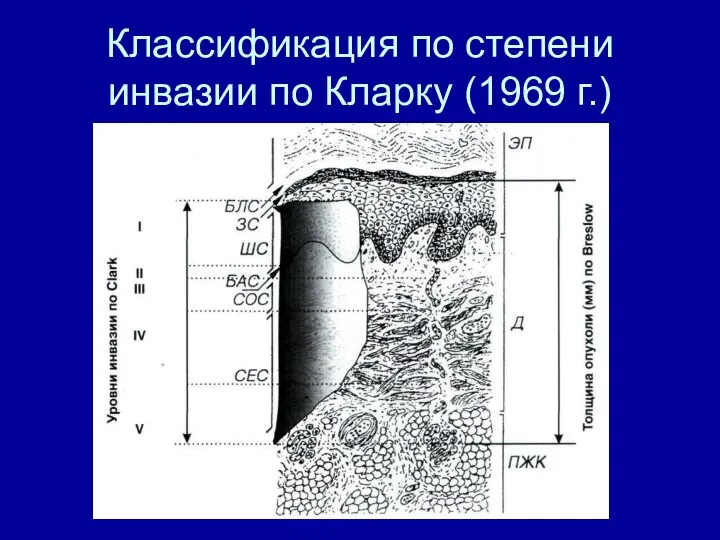 Классификация по степени инвазии по Кларку (1969 г.)