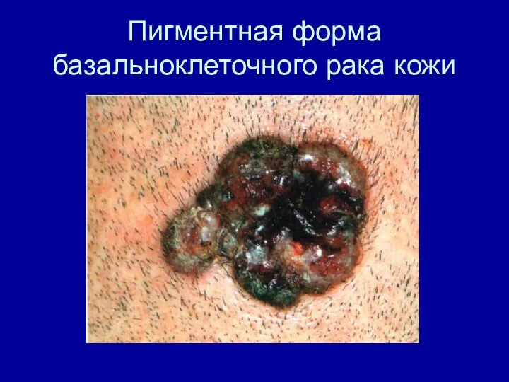 Пигментная форма базальноклеточного рака кожи