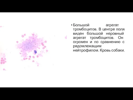 Большой агрегат тромбоцитов. В центре поля виден большой неровный агрегат тромбоцитов. Он