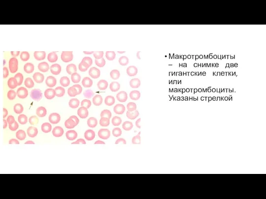 Макротромбоциты – на снимке две гигантские клетки, или макротромбоциты. Указаны стрелкой