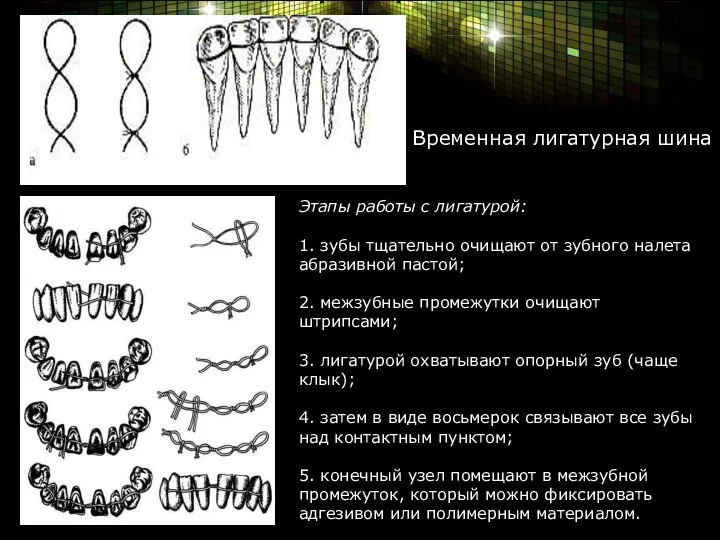 Временная лигатурная шина Этапы работы с лигатурой: 1. зубы тщательно очищают от