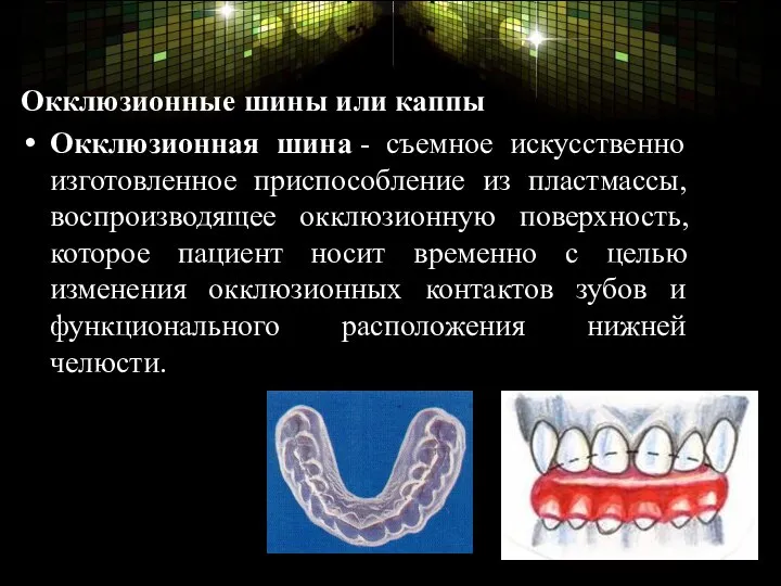 Окклюзионные шины или каппы Окклюзионная шина - съемное искусственно изготовленное приспособление из