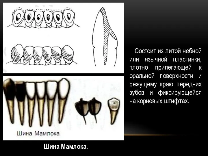 Шина Мамлока. Состоит из литой небной или язычной пластинки, плотно прилегающей к