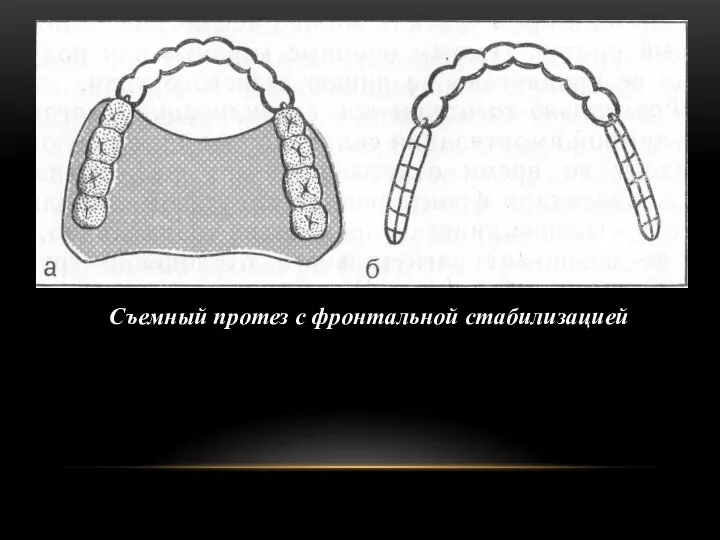 Съемный протез с фронтальной стабилизацией