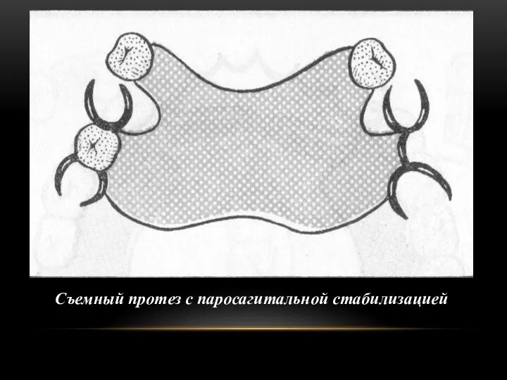 Съемный протез с паросагитальной стабилизацией