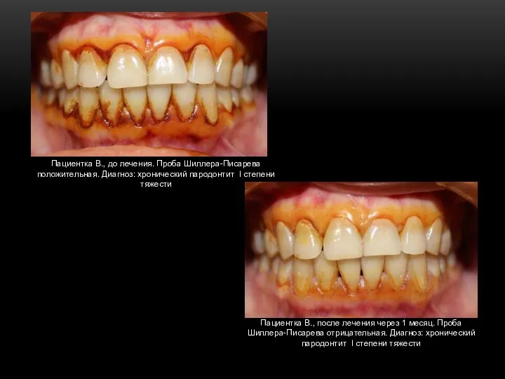 Пациентка В., до лечения. Проба Шиллера-Писарева положительная. Диагноз: хронический пародонтит I степени