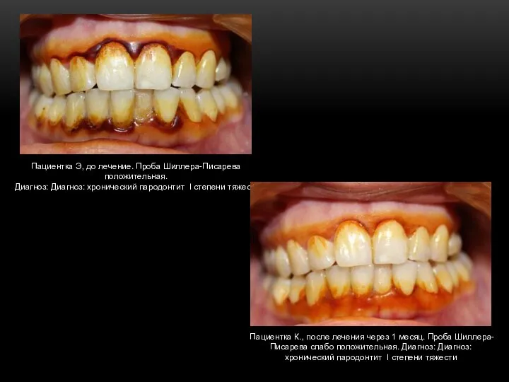 Пациентка Э, до лечение. Проба Шиллера-Писарева положительная. Диагноз: Диагноз: хронический пародонтит I