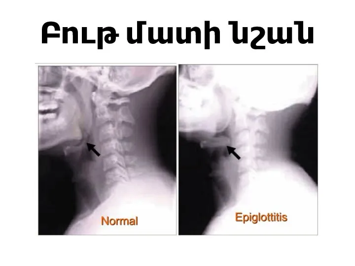 Բութ մատի նշան