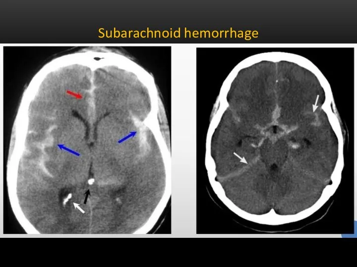 Subarachnoid hemorrhage