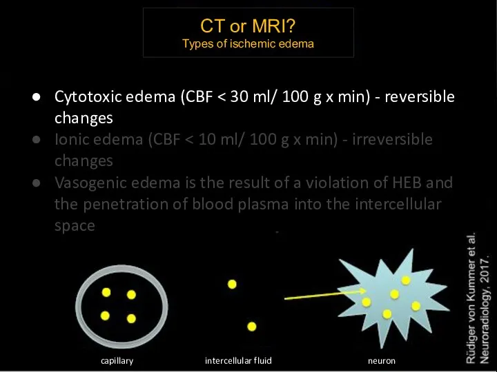 CT or MRI? Types of ischemic edema Cytotoxic edema (CBF Ionic edema