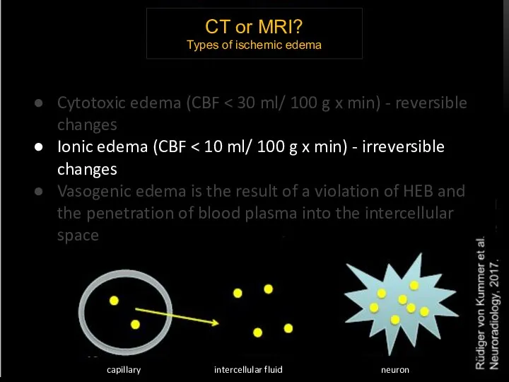 CT or MRI? Types of ischemic edema Cytotoxic edema (CBF Ionic edema