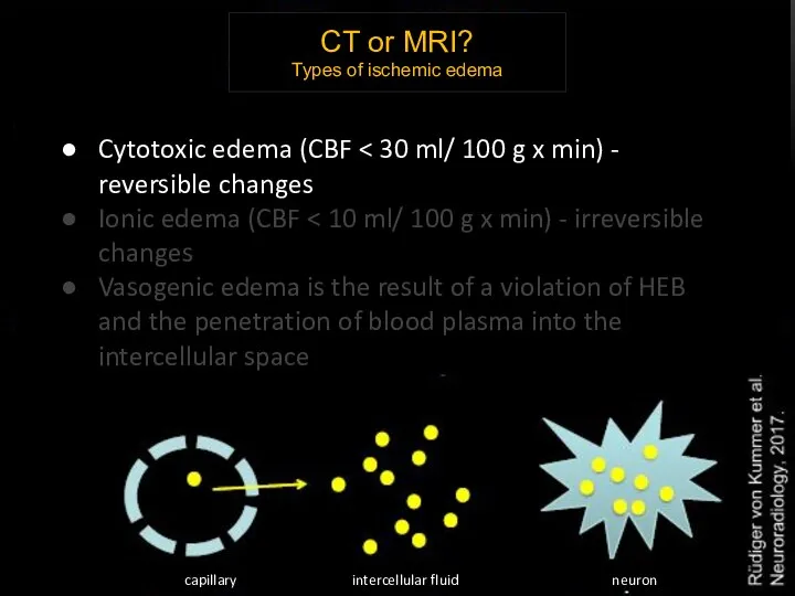 CT or MRI? Types of ischemic edema Cytotoxic edema (CBF Ionic edema