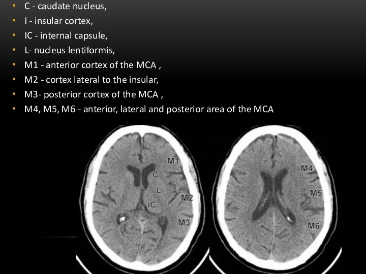 C - caudate nucleus, I - insular cortex, IC - internal capsule,