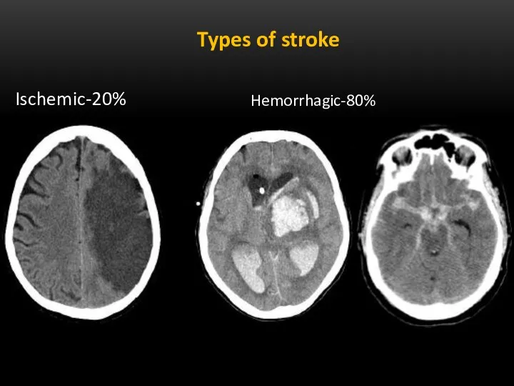 Types of stroke Ischemic-20% Hemorrhagic-80%