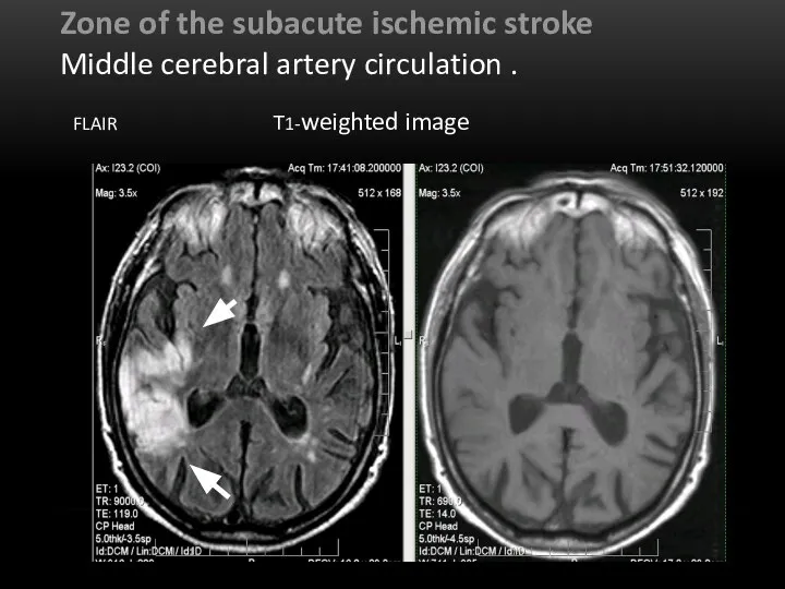 Zone of the subacute ischemic stroke Middle cerebral artery circulation . FLAIR Т1-weighted image