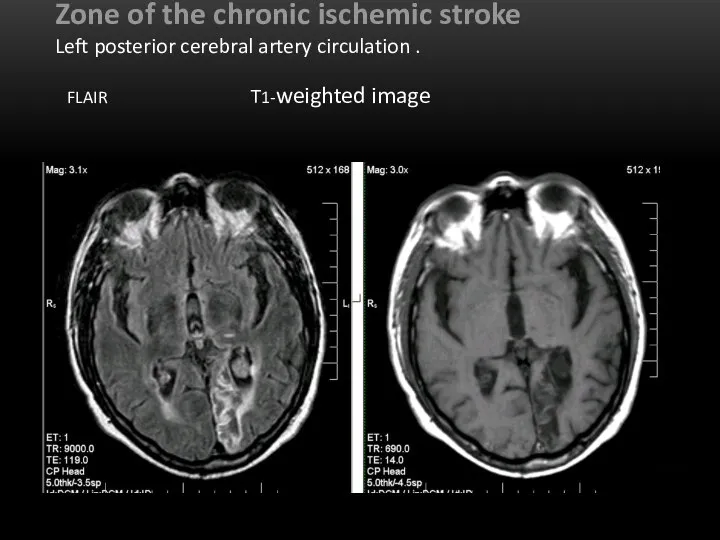 Zone of the chronic ischemic stroke Left posterior cerebral artery circulation . FLAIR Т1-weighted image