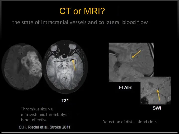 CT or MRI? the state of intracranial vessels and collateral blood flow