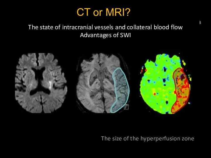 CT or MRI? The state of intracranial vessels and collateral blood flow
