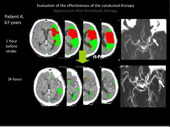 Evaluation of the effectiveness of the conducted therapy Reperfusion after thrombolic therapy