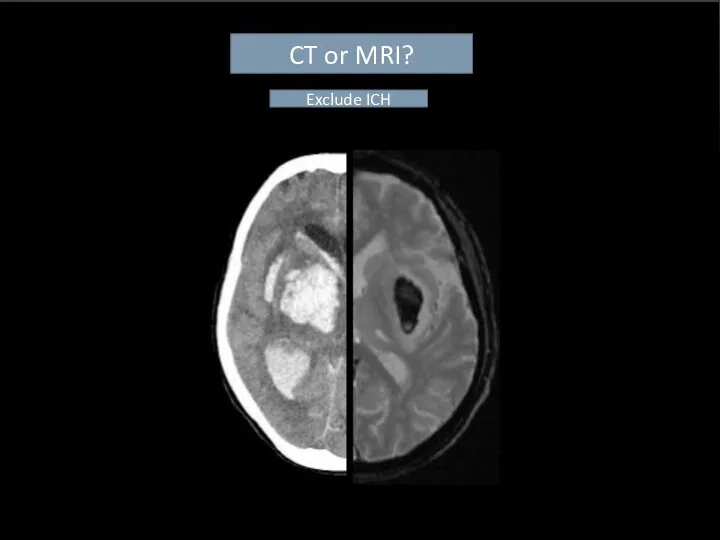 CT or MRI? Exclude ICH