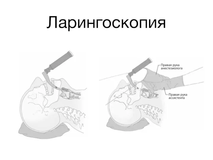 Ларингоскопия