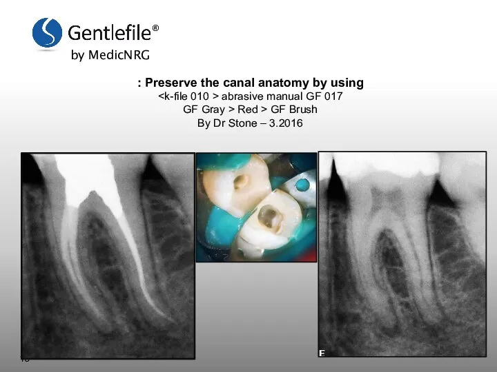 Preserve the canal anatomy by using : k-file 010 > abrasive manual