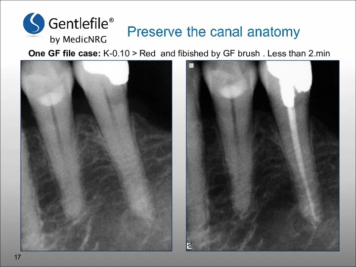One GF file case: K-0.10 > Red and fibished by GF brush . Less than 2.min