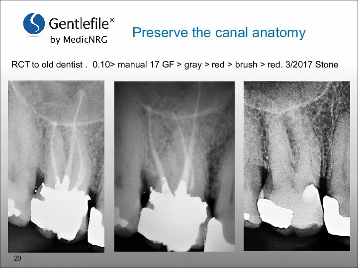 RCT to old dentist . 0.10> manual 17 GF > gray >