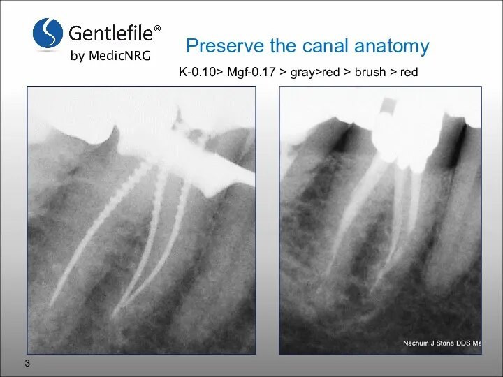 Preserve the canal anatomy K-0.10> Mgf-0.17 > gray>red > brush > red