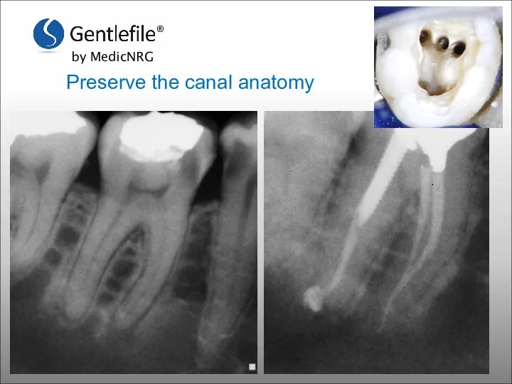 Preserve the canal anatomy