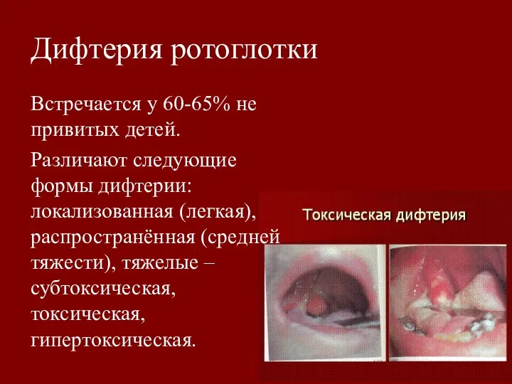 Дифтерия ротоглотки Встречается у 60-65% не привитых детей. Различают следующие формы дифтерии: