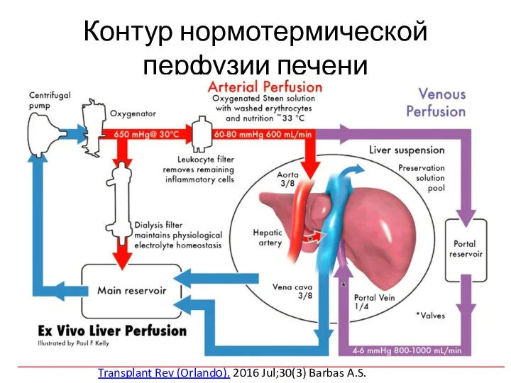 Контур нормотермической перфузии печени Transplant Rev (Orlandо). 2016 Jul;30(3) Barbas A.S.